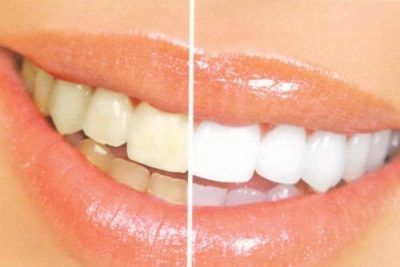 Woman's Teeth Before and After Teeth Whitening Service