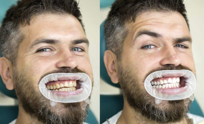Before and After Teeth Whitening Comparison