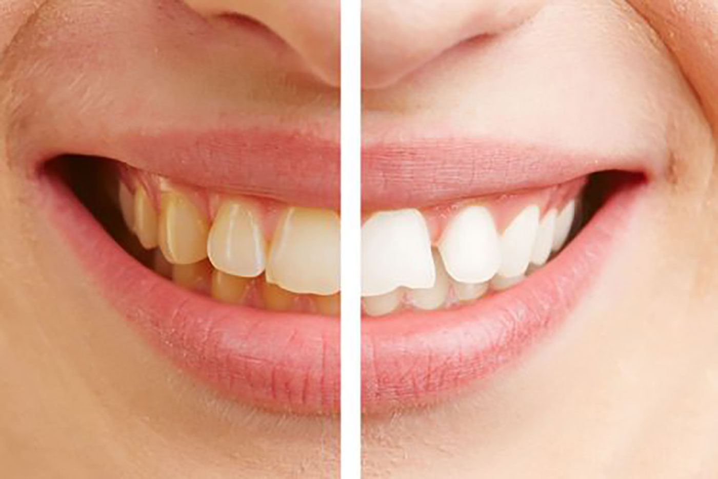 Before and After Teeth Whitening